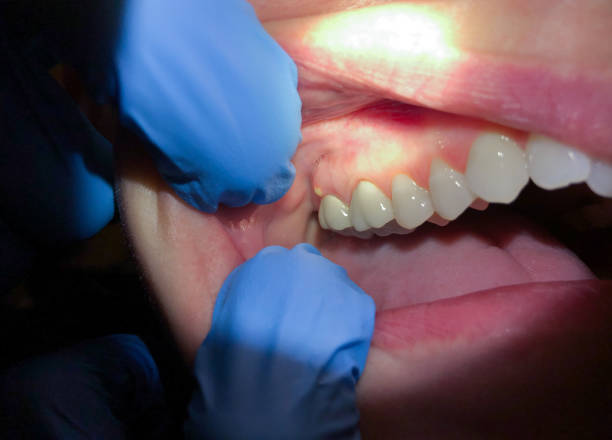Best Lost Filling or Crown Replacement in Cedar Hills, OR